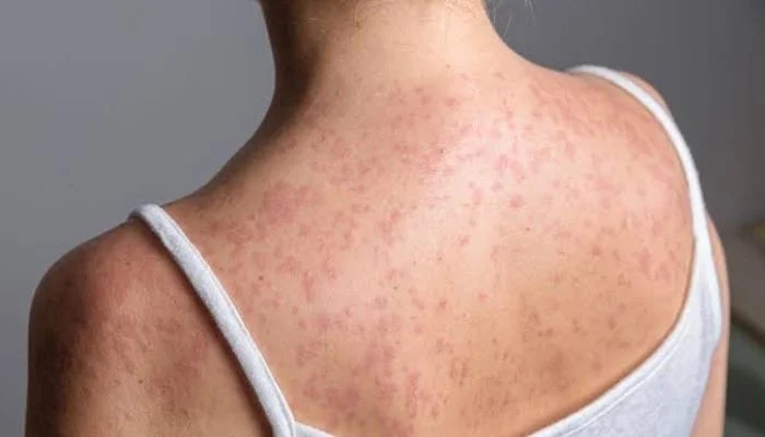 Measles Claims Two Unvaccinated Lives In Pennsylvania