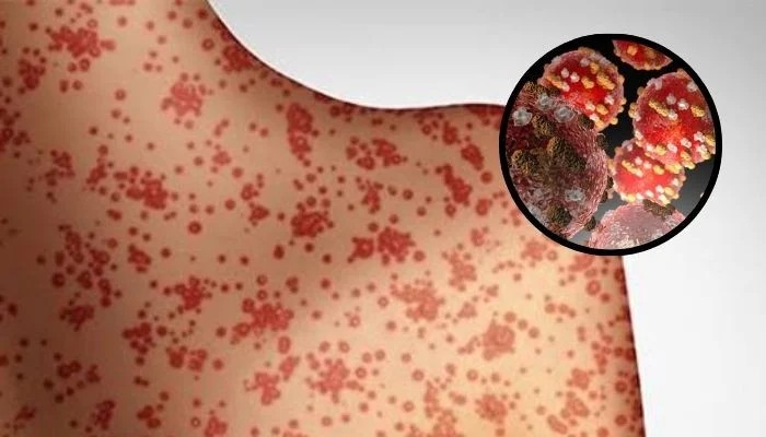 Measles Resurgence Hits US: Cases Surge Past 2,900 Amid Rising Health Concerns
