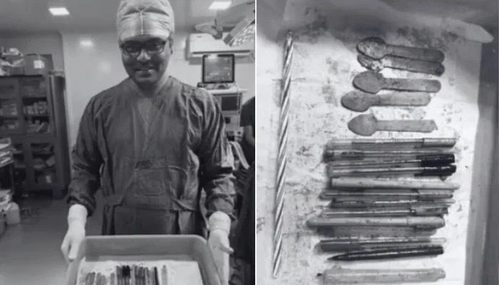 Doctors Remove 14 Pens Spoons Candle From Womans Stomach In India