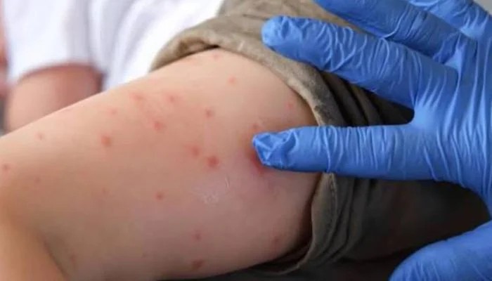 Pennsylvania Reports Most Measles Death In US Over 30 Years Heres Update